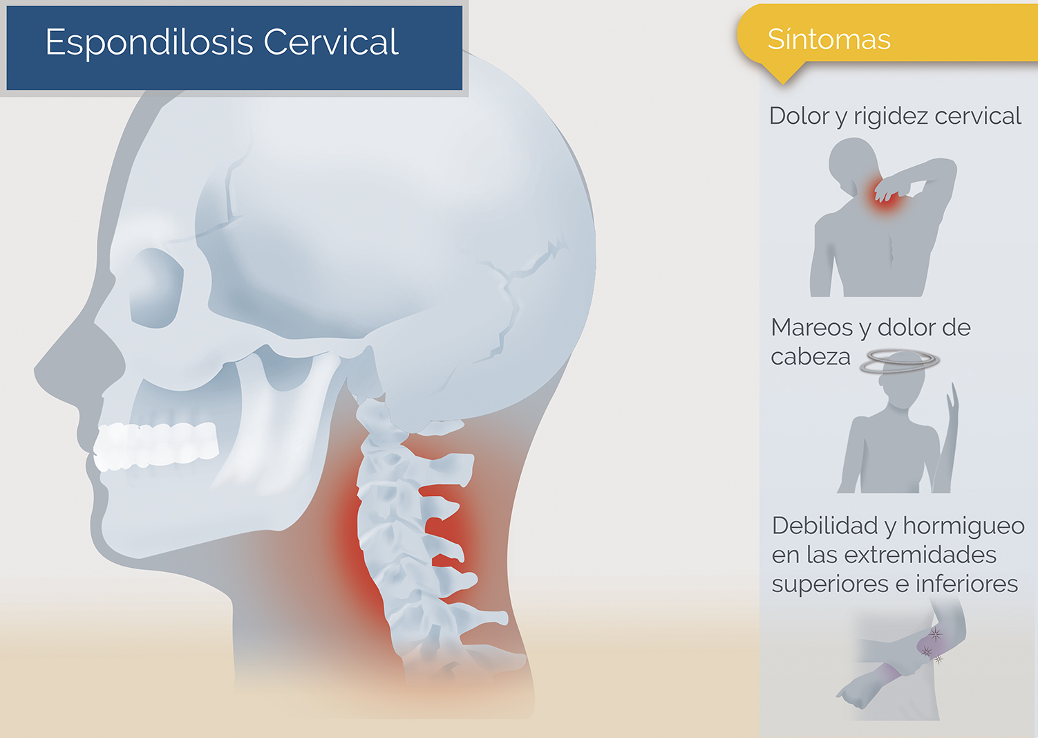 Dolor cervical: qué es, síntomas y tratamiento