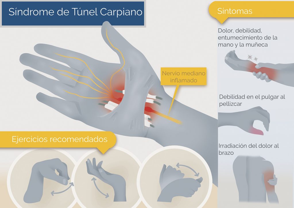 Síndrome del Túnel Carpiano, tratamiento desde la neurofisiología -  Hospital Cruz Roja de Córdoba