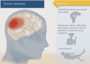 síntomas del tumor cerebral