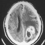 diagnóstico del tumor cerebral