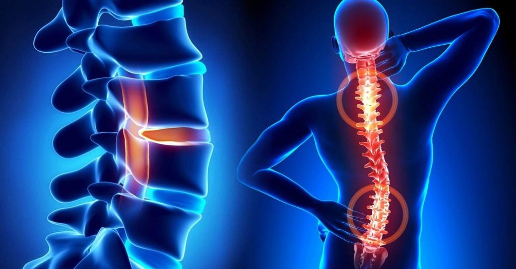 Las cinco lesiones más comunes de los discos intervertebrales