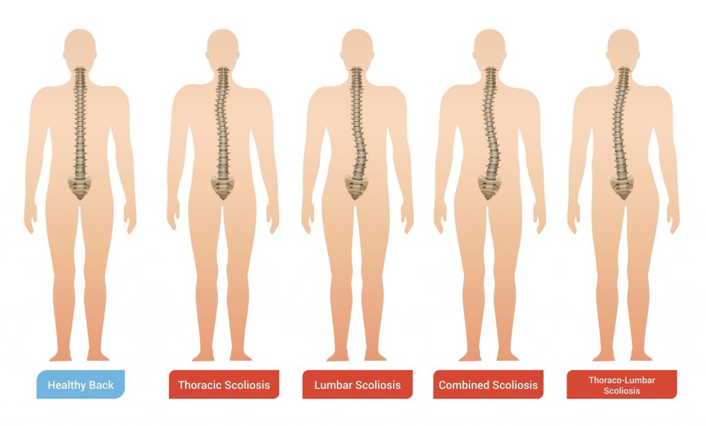 Hay varios tipos de escoliosis en función de la zona de la espalda a la que afecte