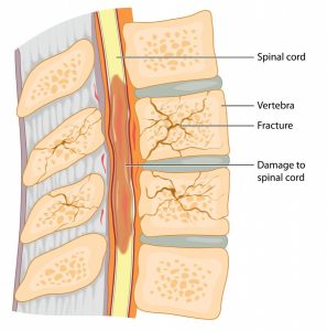 Las cirugías de columna permiten descomprimir, movilizar los elementos, fijar estructuras vertebrales y sustituirlas