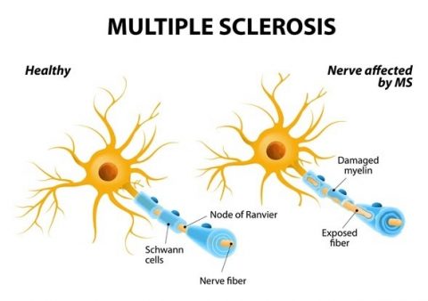 Seis claves para conocer la esclerosis múltiple - Neurocirugía de la Torre