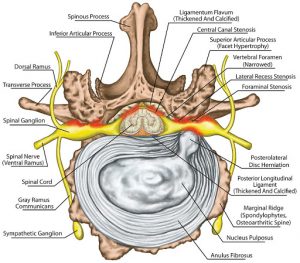 La hernia discal se produce cuando todo o parte de un disco de la columna se sale de su lugar