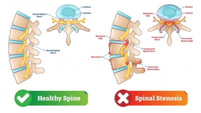 La estenosis espinal es una de las patologías en la columna vertebral más comunes en personas mayores de 50 años