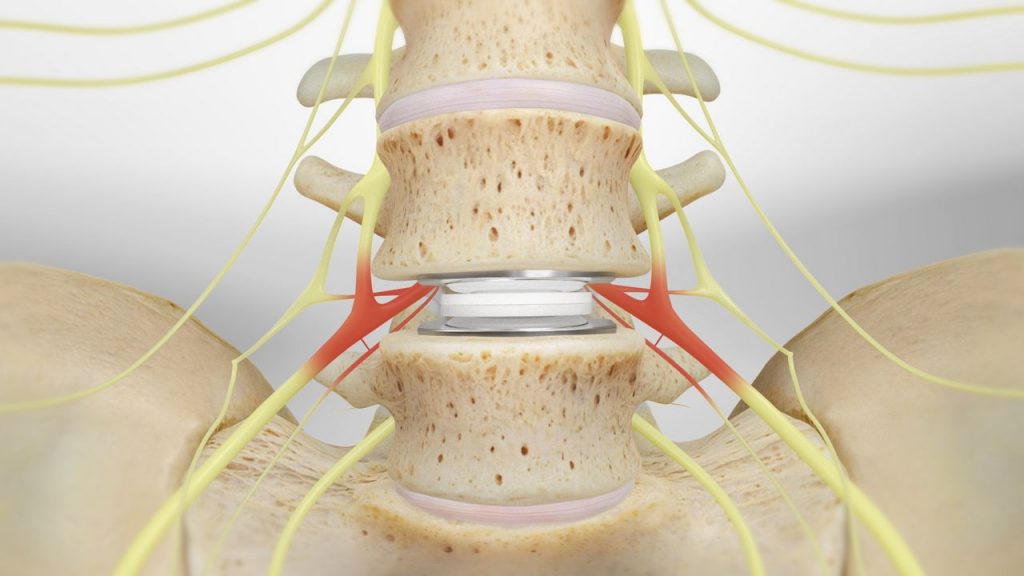 La implantación es una cirugía de columna que consiste en la eliminación del disco afectado