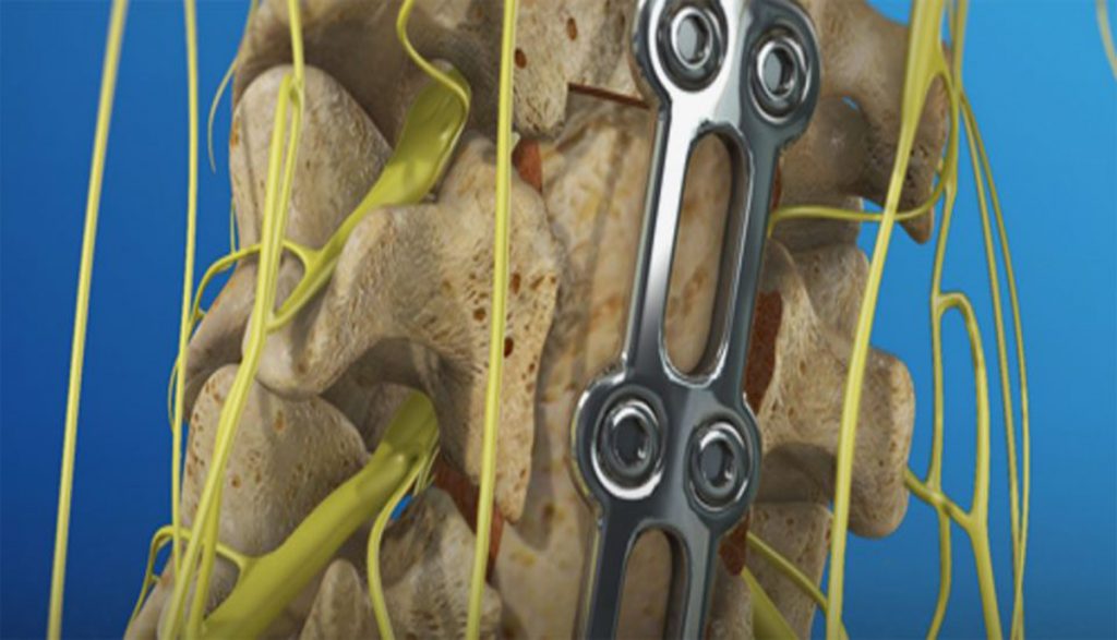 La corporectomía es una técnica quirúrgica que se utiliza en neurocirugía para extraer un cuerpo vertebral