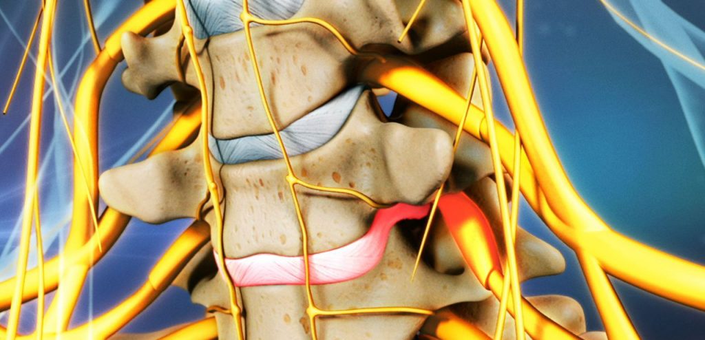 La hernia discal cervical es una patología que afecta a la zona del cuello de la columna vertebral