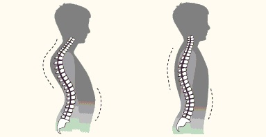curvatura de la espalda: cifosis dorsal