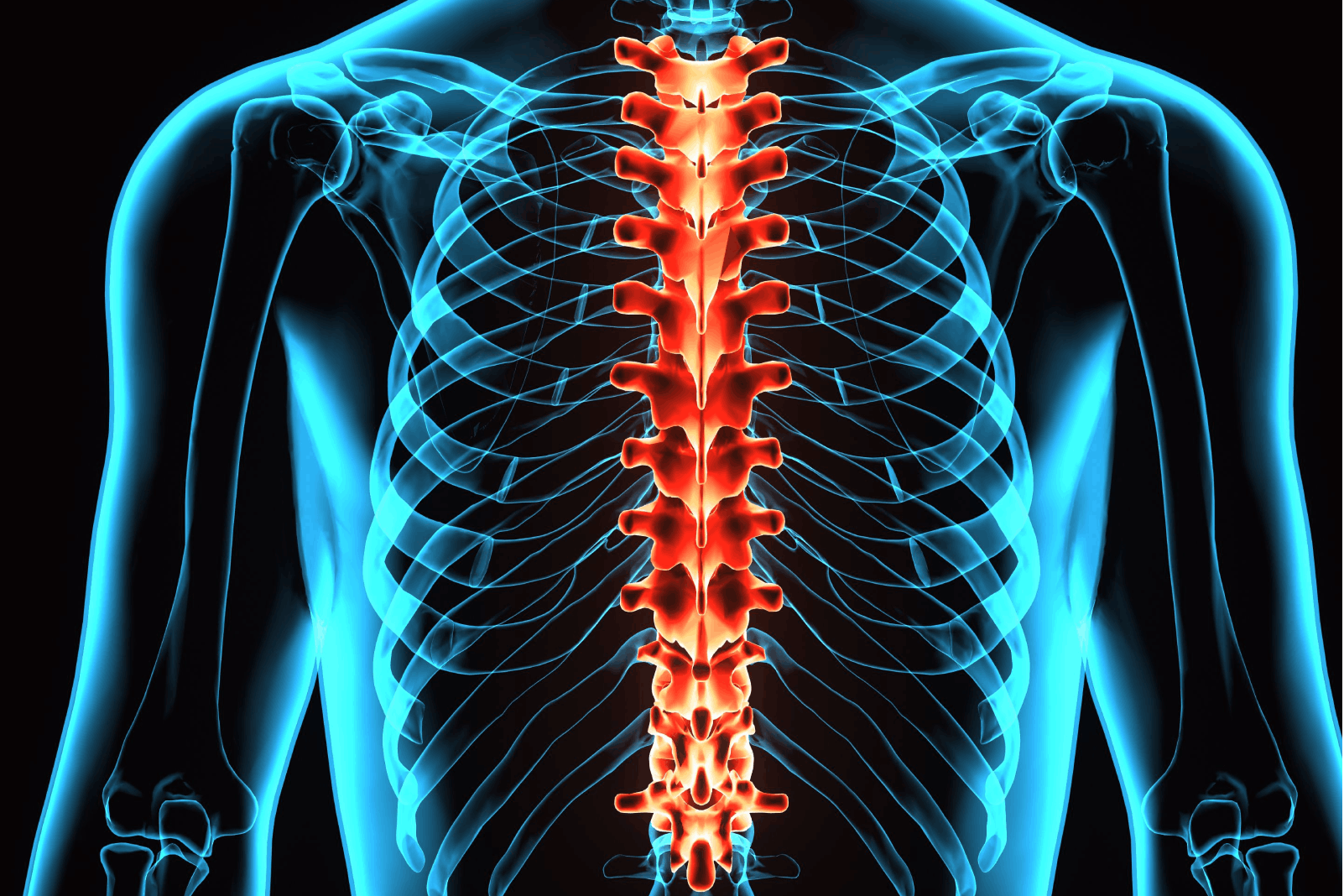 Curvatura de la espalda: ¿Qué es la cifosis dorsal? - Neurocirugía de la  Torre