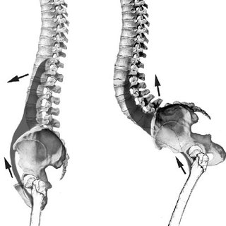 hip-flexion-contracture-a-could-be-responsible-for-the-onset-of-lumbar-hyperlordosis-q320.jpg