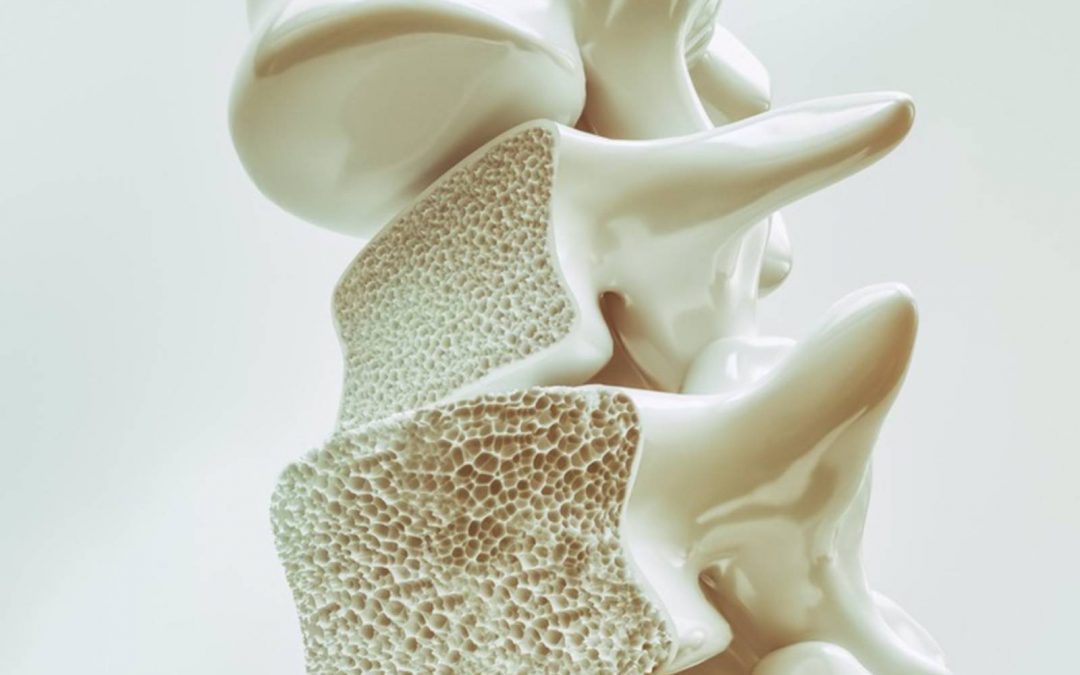 Osteoporosis: qué es, factores de riesgo y tratamiento