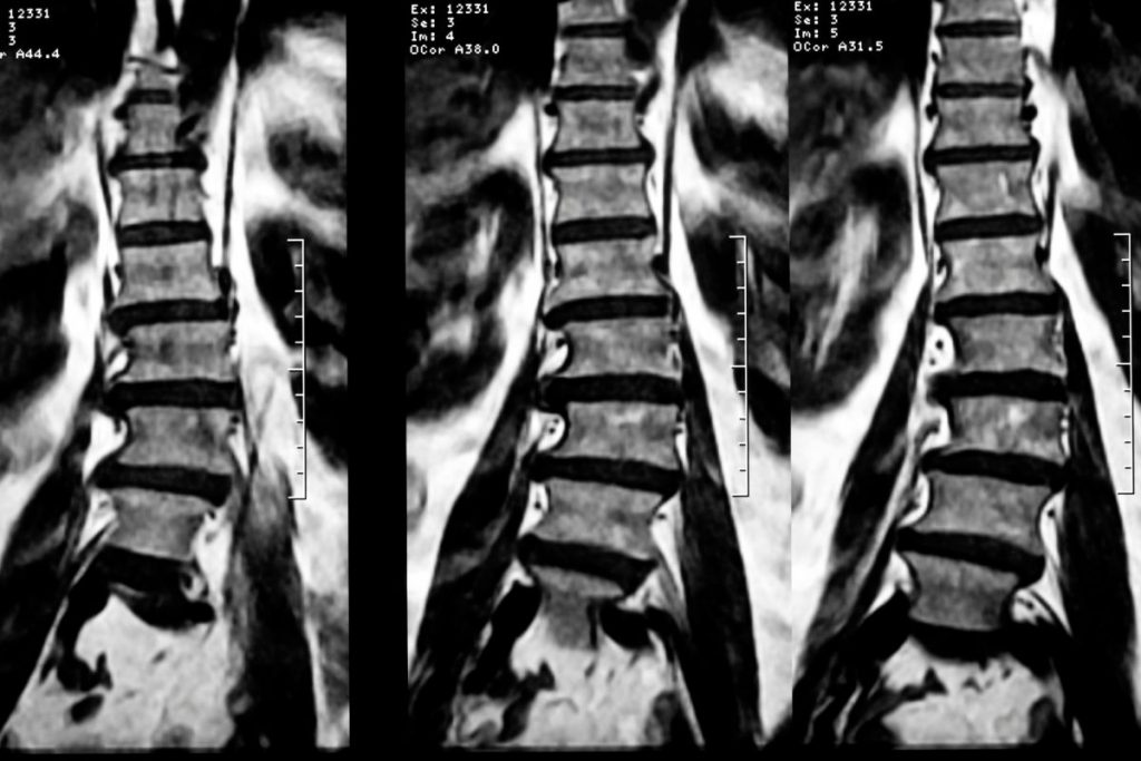 radiografía de una columna que muestra Discopatía Degenerativa Lumbar