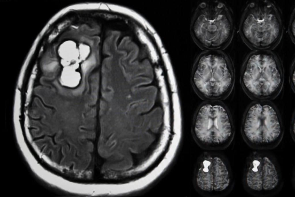Imagen de una resonancia magnética que muestra un tumor cerebral - una masa oscura en el cerebro.